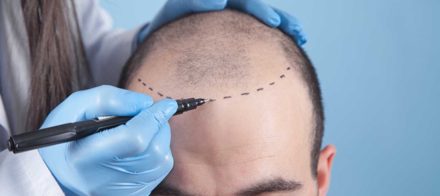 Forehead Reduction SurgeryPros &amp; ConsLearn from doctor