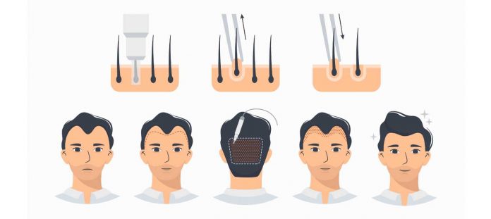 Hair plugs - pros and cons