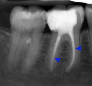 Root canal X ray with filling