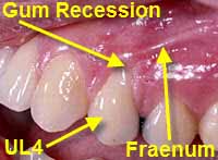 gum graft is done to treat gum recession