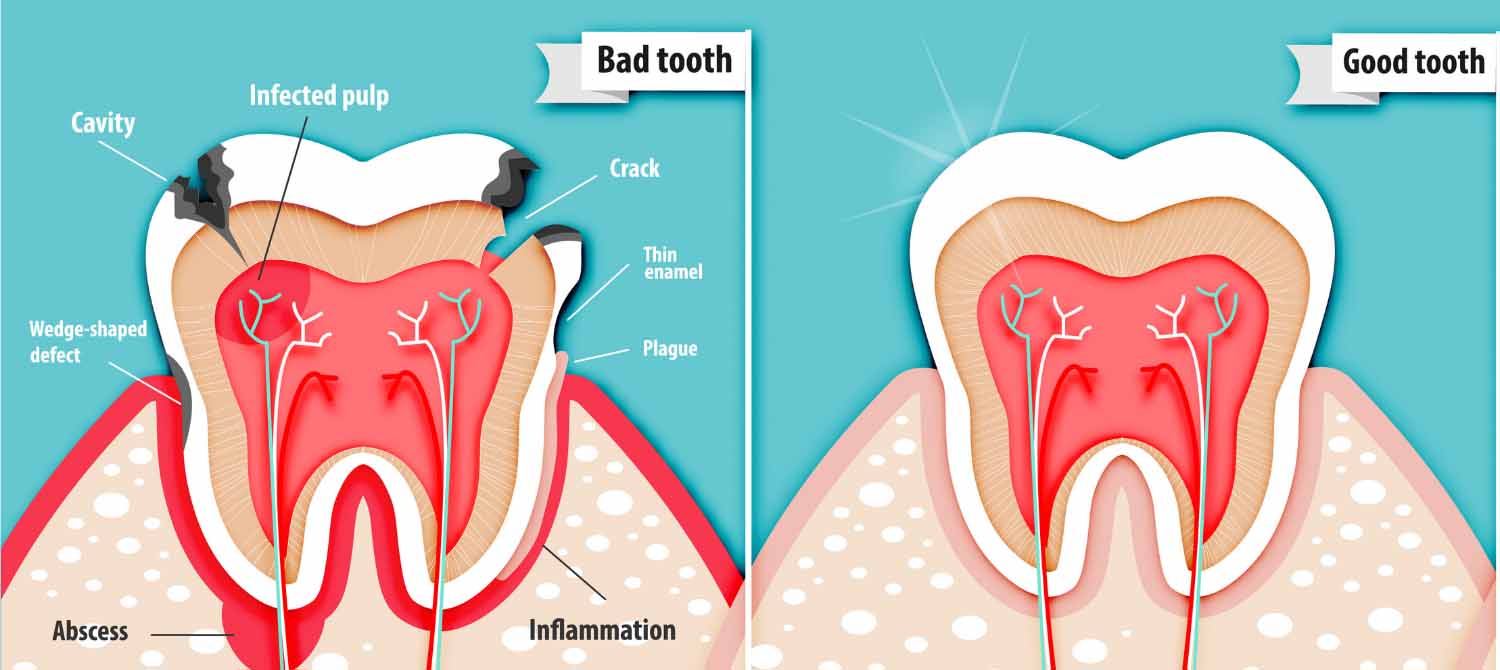 how long does a root canal take depends on your teeth condition