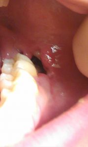 pictures of dry socket third molar