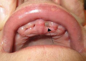 pictures of dry socket upper tooth