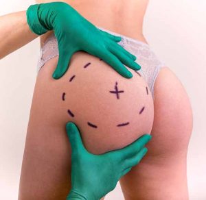 the surgeon will examine your butt during consultation for butt implants procedure