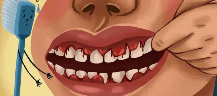 Gum recession - a common dental condition