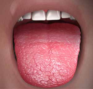 Adderall tongue - dry tongue