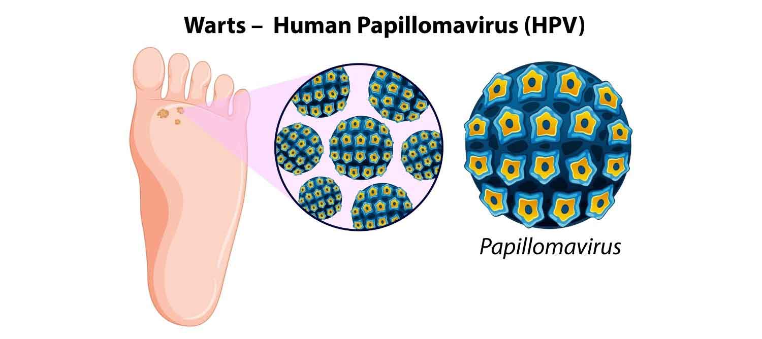 Corn Vs Wart | How To Differentiate | Learn from doctor