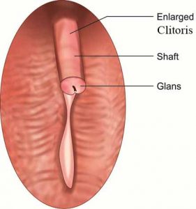 Enlarged clitoris-clitoromegaly