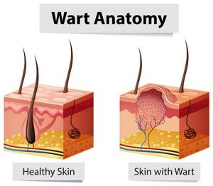 Wart anatomy