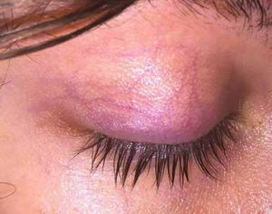 Red prominent veins on the eyelid