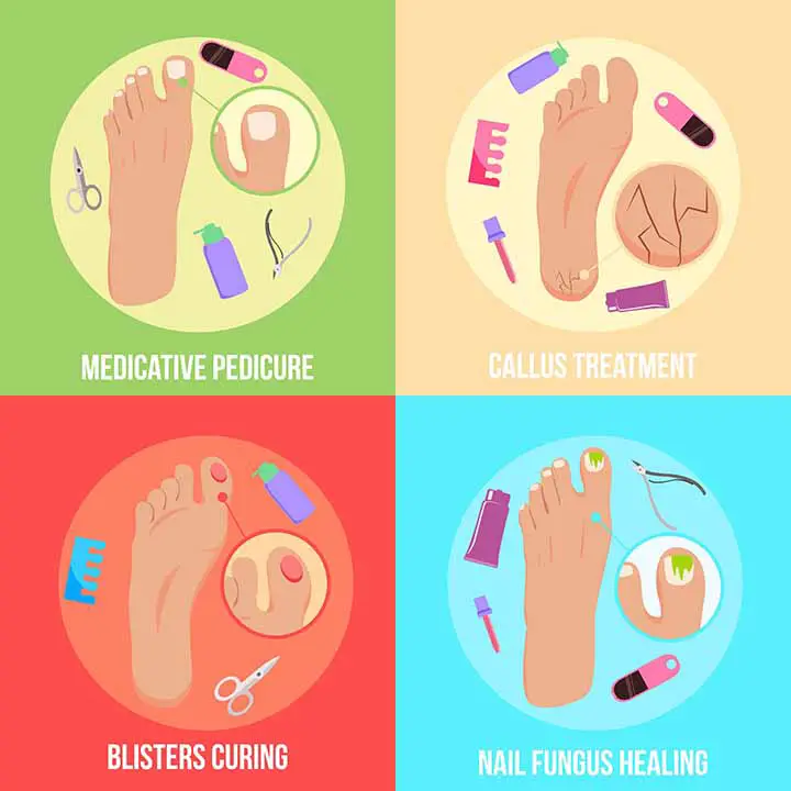 Feet Fungus - athlete's foot treatment infographics