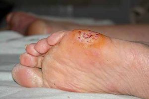 Nasty Feet Fungus - Athlete's foot