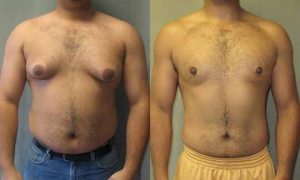 Puffy nipples treatment without surgery