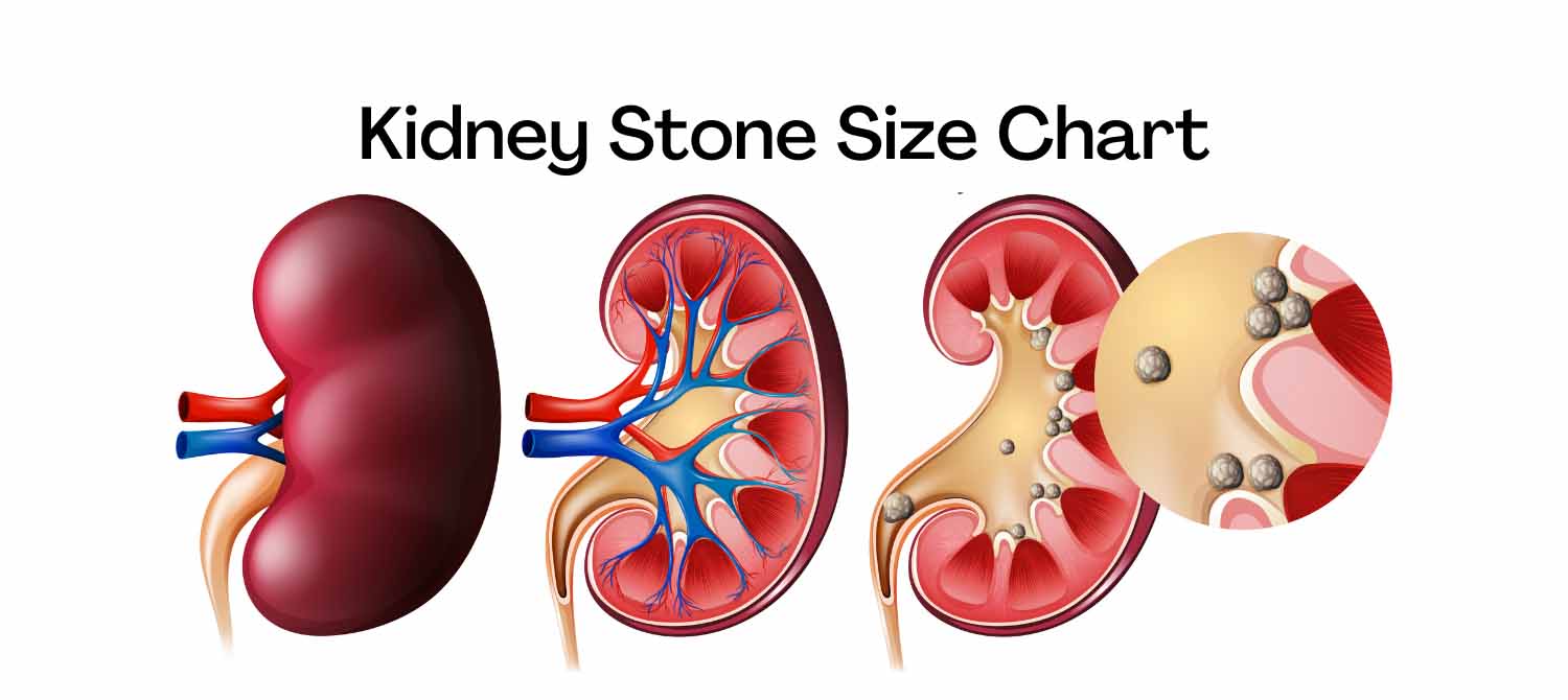 Kidney Stone Size Chart in MM and CM Learn from doctor
