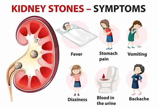 Kidney stones symptoms Infographics